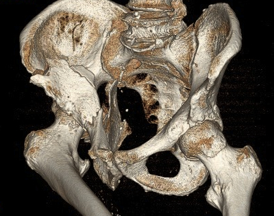 Acetabular Fracture CT Reconstruction